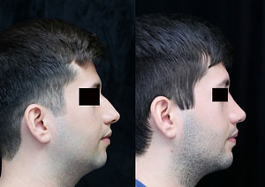 chin augmentation, rhinoplasty, neck liposuction right