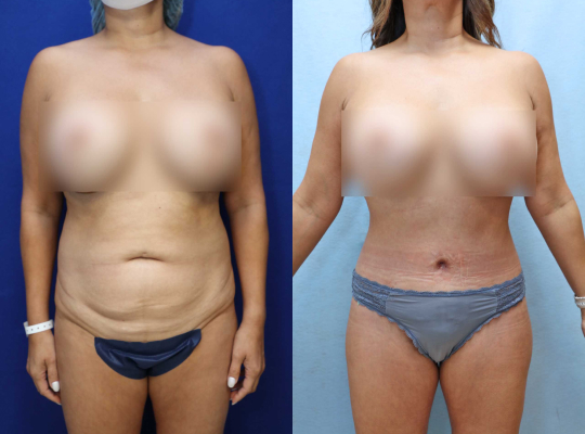 Tummy Tuck Results Oranage County  Santa Ana