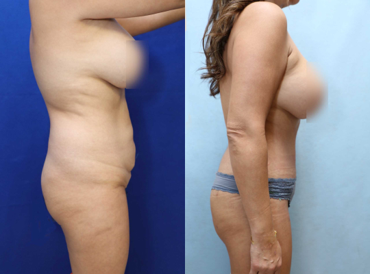 Tummy Tuck Results Oranage County  Santa Ana