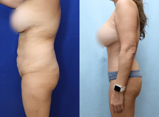 Tummy Tuck Before & After Photos