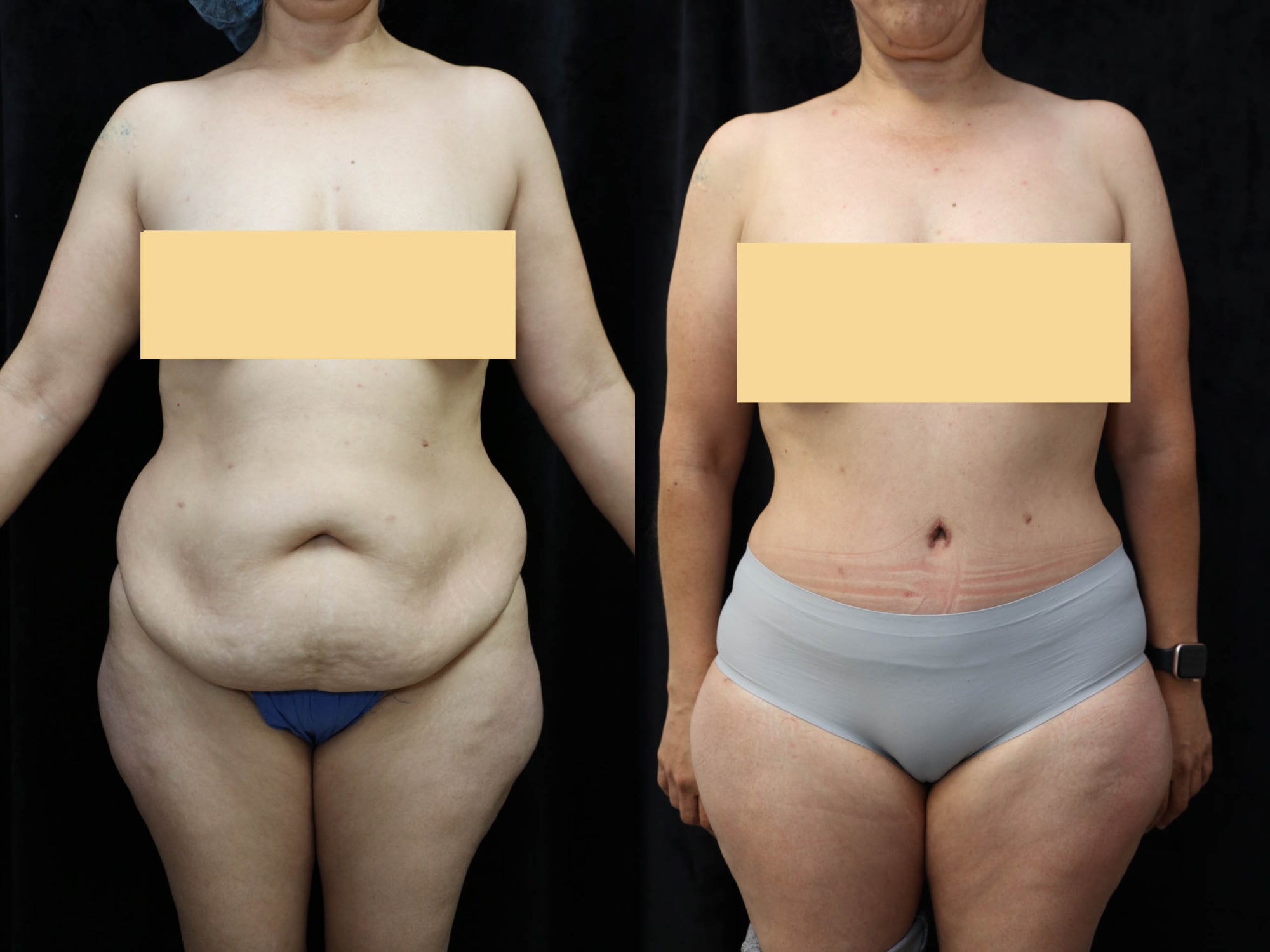 Tummy Tuck Before & After Photos