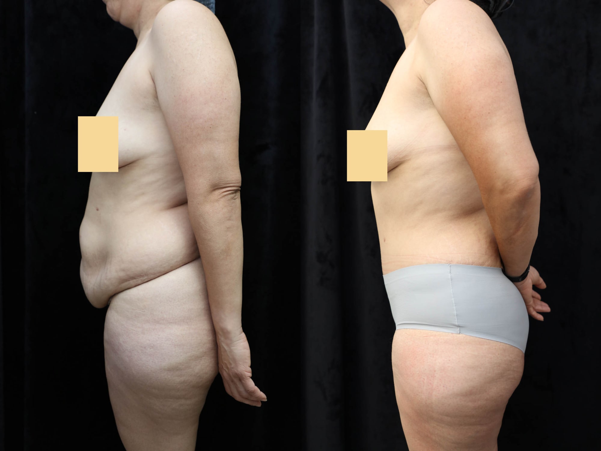 Tummy Tuck Before & After Photos