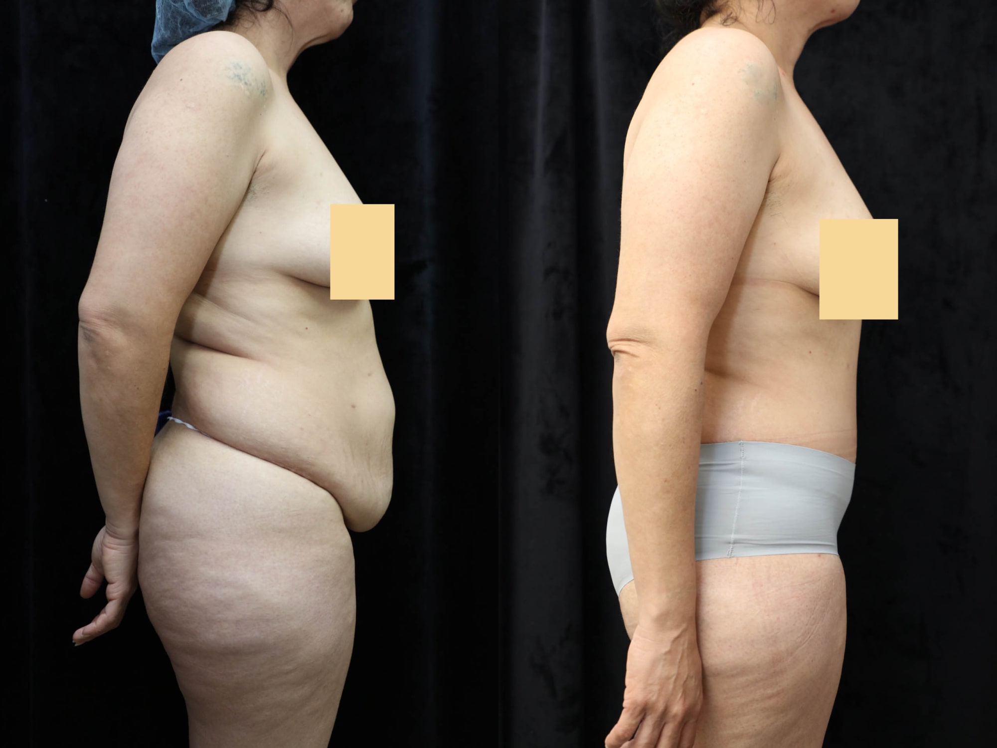 Tummy Tuck Before & After Photos