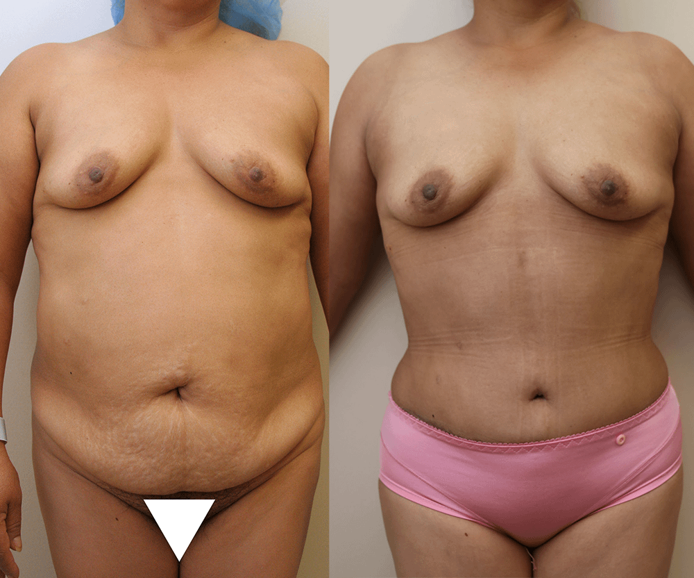 Tummy Tuck Before & After Photos