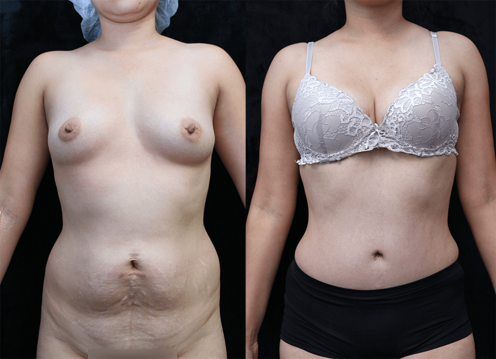 Tummy Tuck Before & After Photos