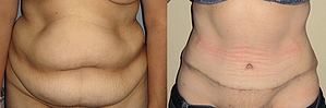 Tummy Tuck Before & After Photos