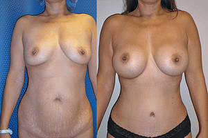 Mommy Makeover & Tummy Tuck Before & After Photos Front