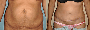 Tummy Tuck Before & After Photos