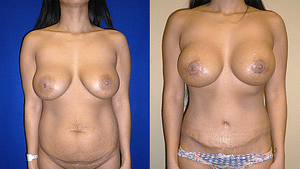 Mommy Makeover & Tummy Tuck Surgery Before & After Photos Front