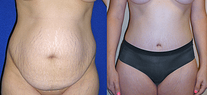 Tummy Tuck Before & After Photos