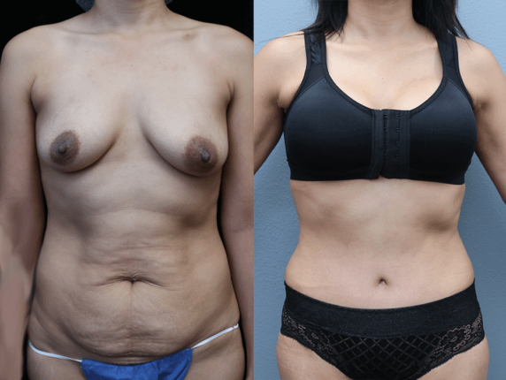 Tummy Tuck Before & After Photos