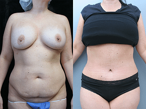 Tummy Tuck Before & After Photos