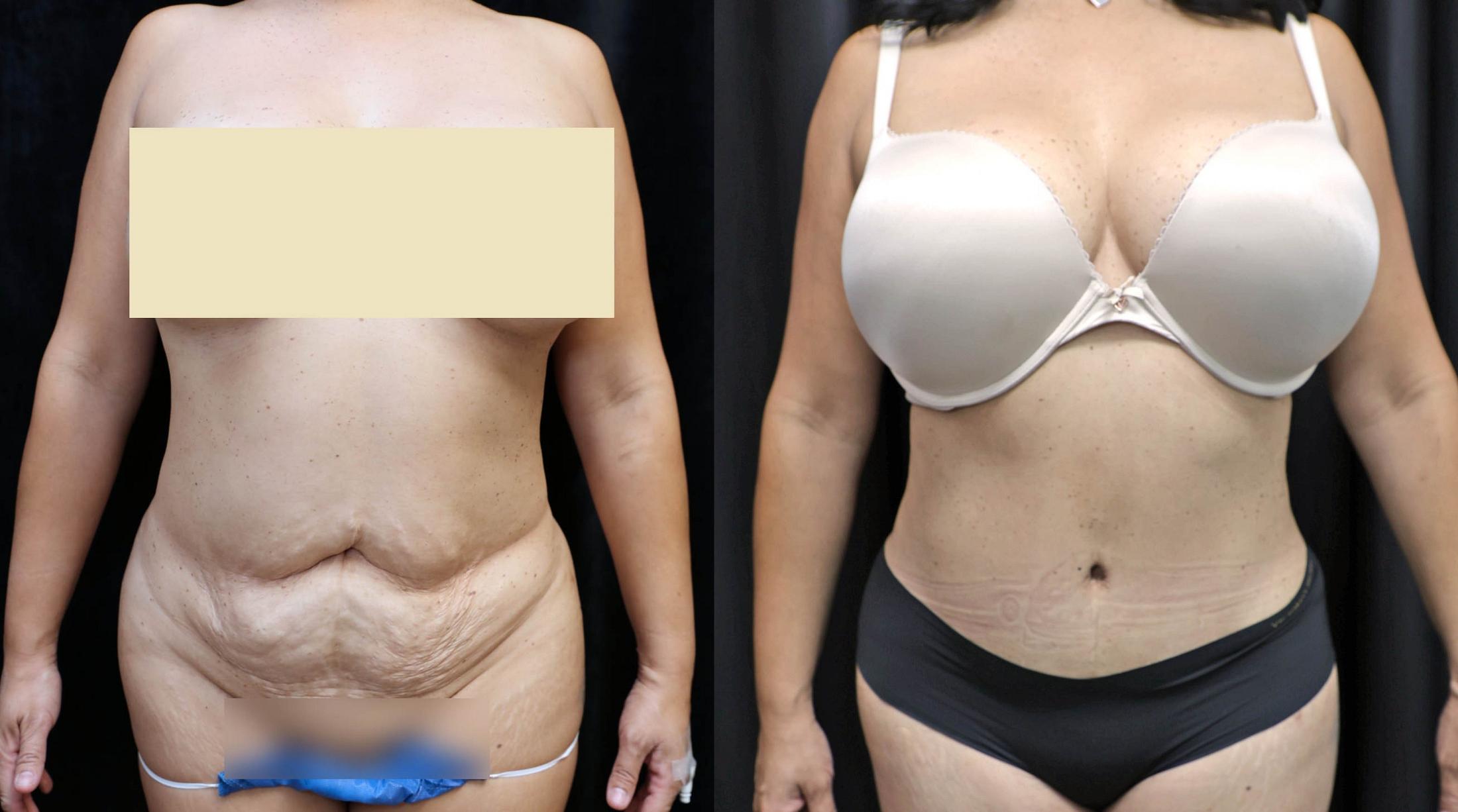 Tummy Tuck Before & After Photos