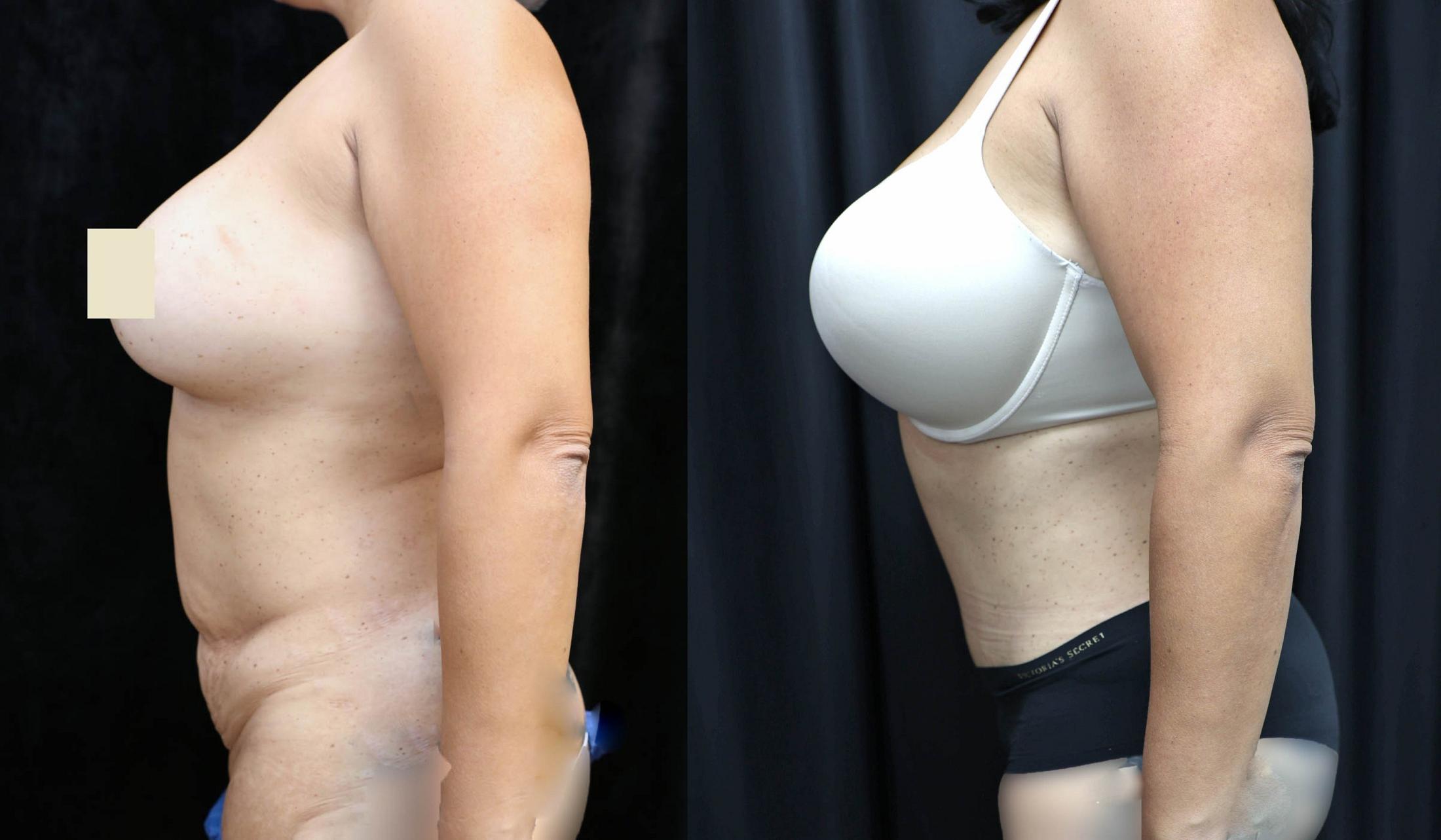 Tummy Tuck Before & After Photos