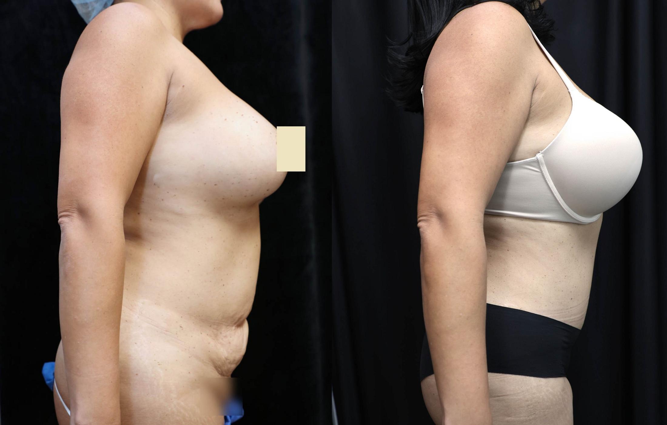 Tummy Tuck Before & After Photos