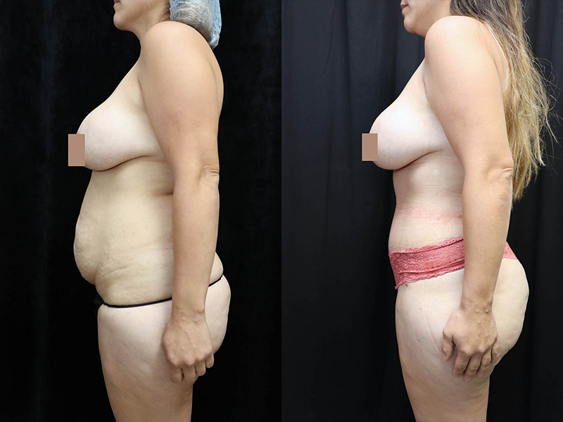 Tummy Tuck Before & After Photos