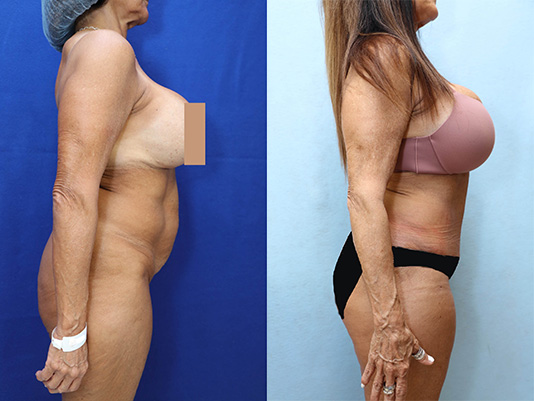 Tummy Tuck Before & After Photos
