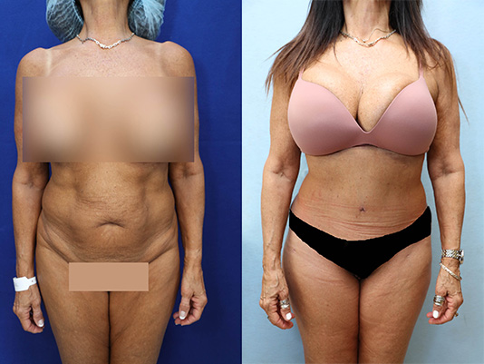 Tummy Tuck Before & After Photos