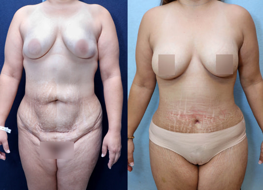 Tummy Tuck Before & After Photos