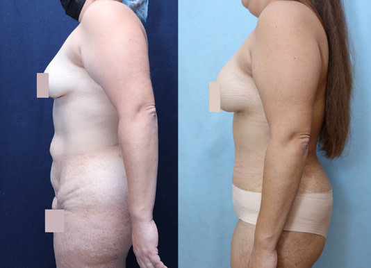 Tummy Tuck Before & After Photos