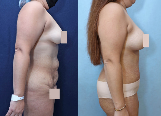 Tummy Tuck Before & After Photos