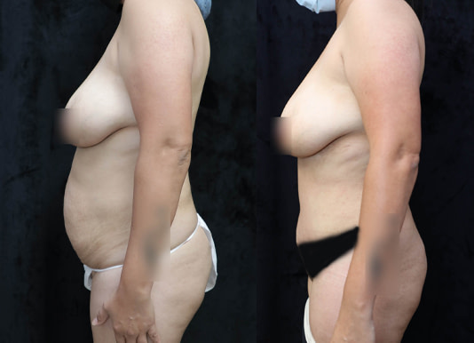 Tummy Tuck Before & After Photos