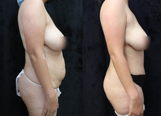 Tummy Tuck Before & After Photos