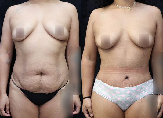Tummy Tuck Before & After Photos