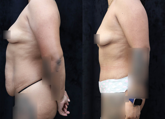 Tummy Tuck Before & After Photos