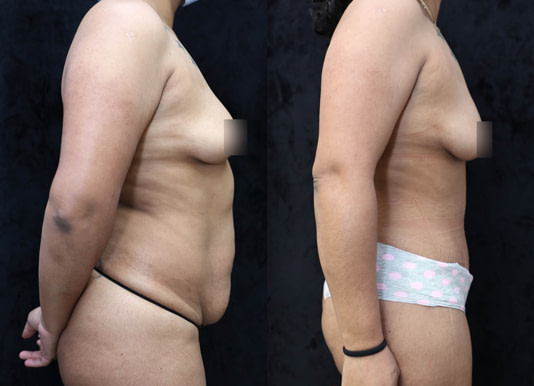 Tummy Tuck Before & After Photos