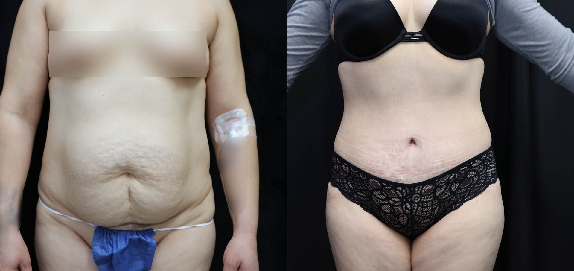 Tummy Tuck Before & After Photos