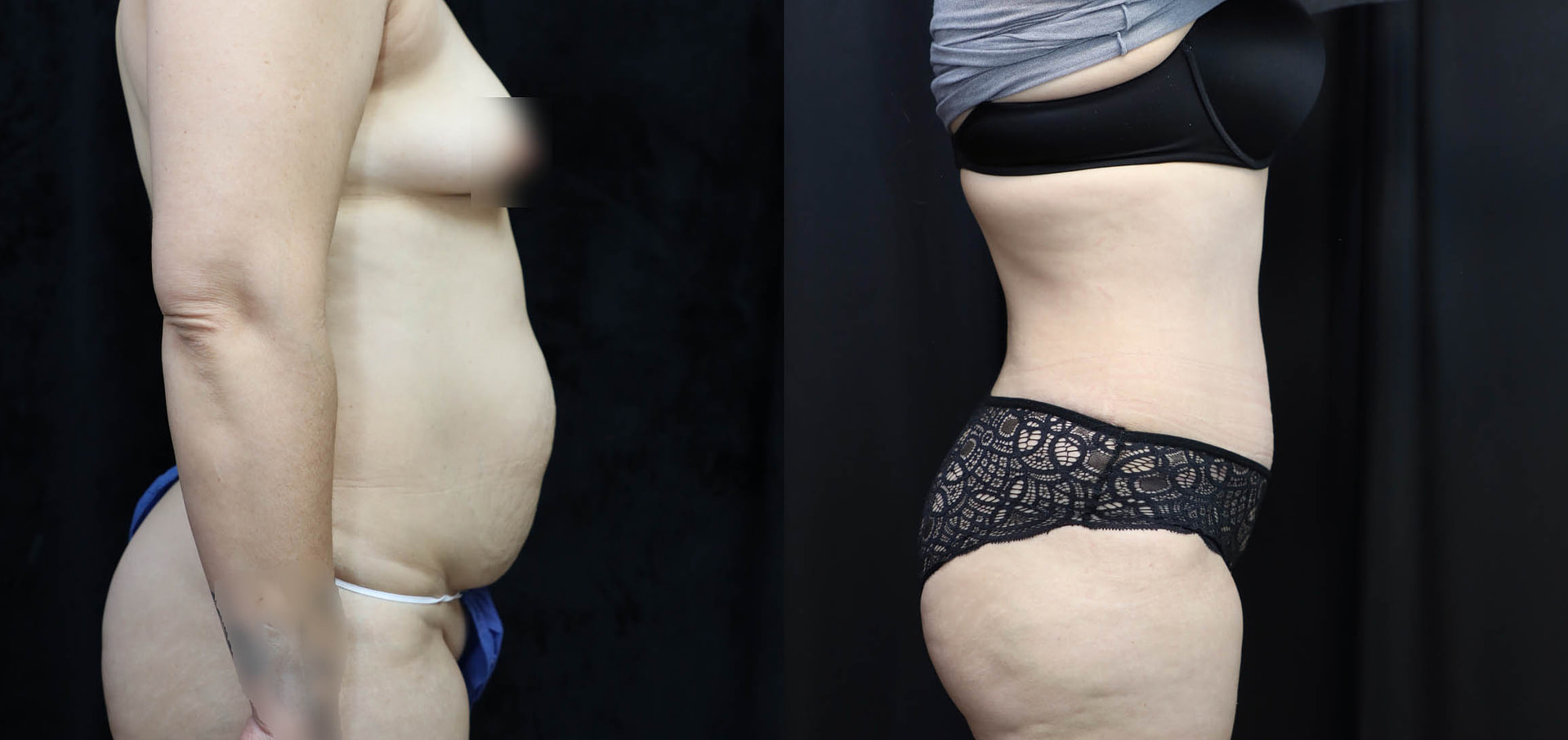 Tummy Tuck Before & After Photos