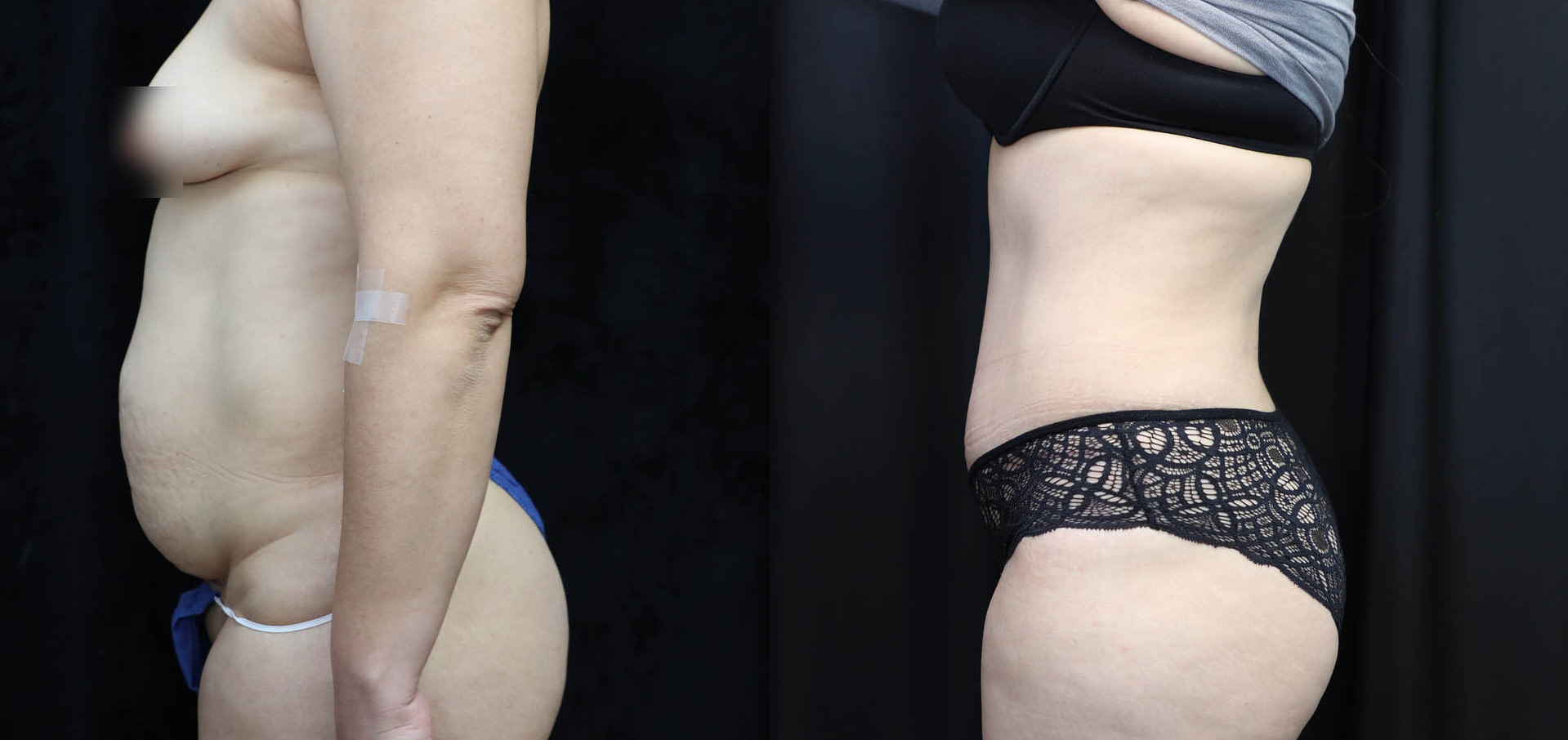 Tummy Tuck Before & After Photos