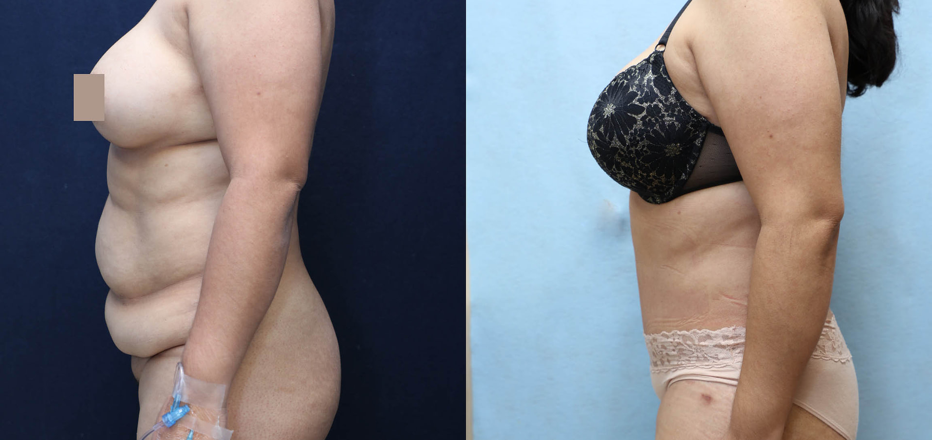 Tummy Tuck Before & After Photos