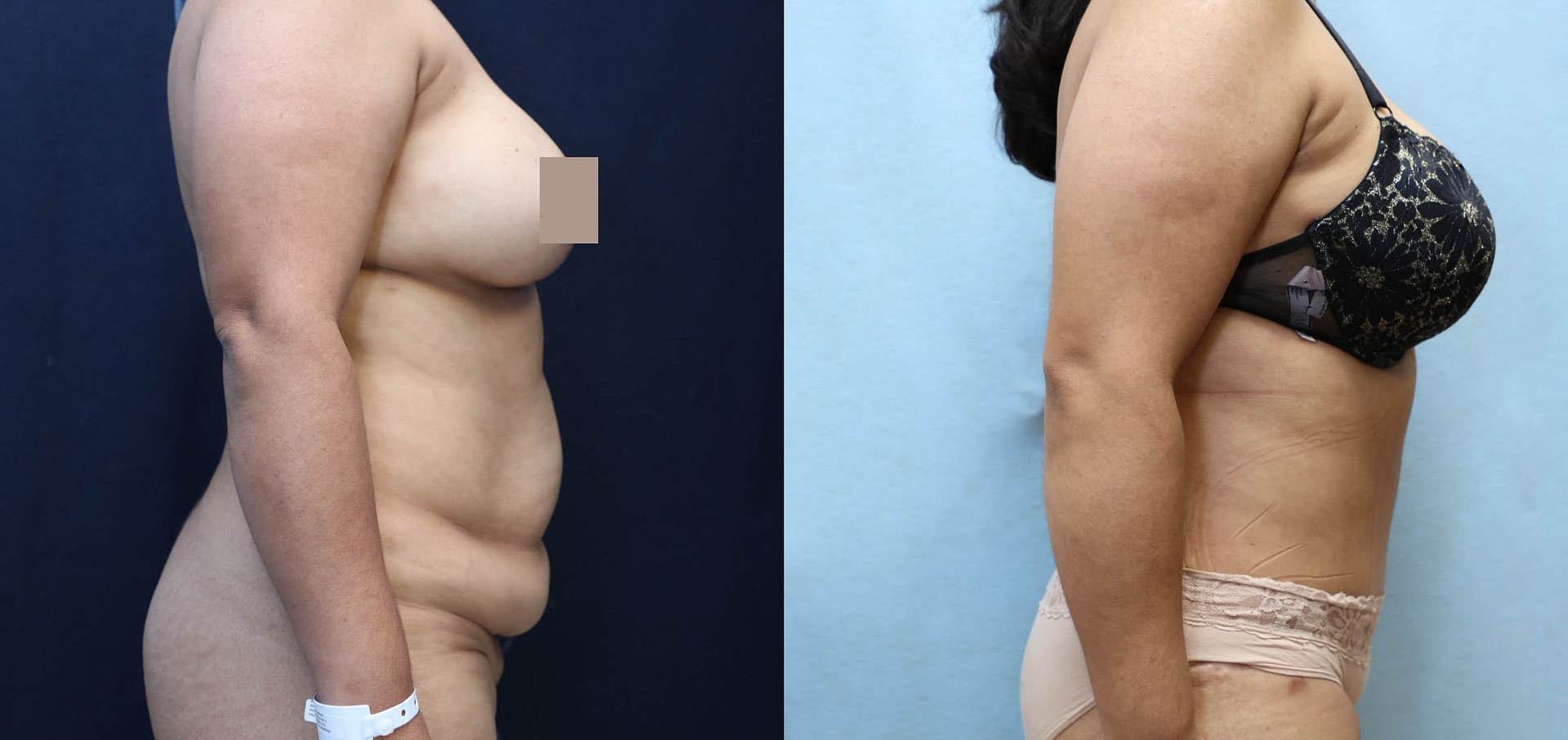 Tummy Tuck Before & After Photos