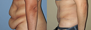 Tummy Tuck Before & After Photos