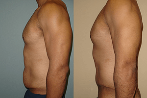 Tummy Tuck Before & After Photos Left
