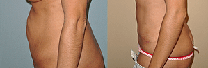 Tummy Tuck Before & After Photos