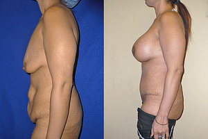 Mommy Makeover & Tummy Tuck Surgery Before & After Photos Left