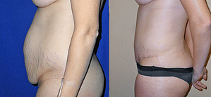 Tummy Tuck Before & After Photos