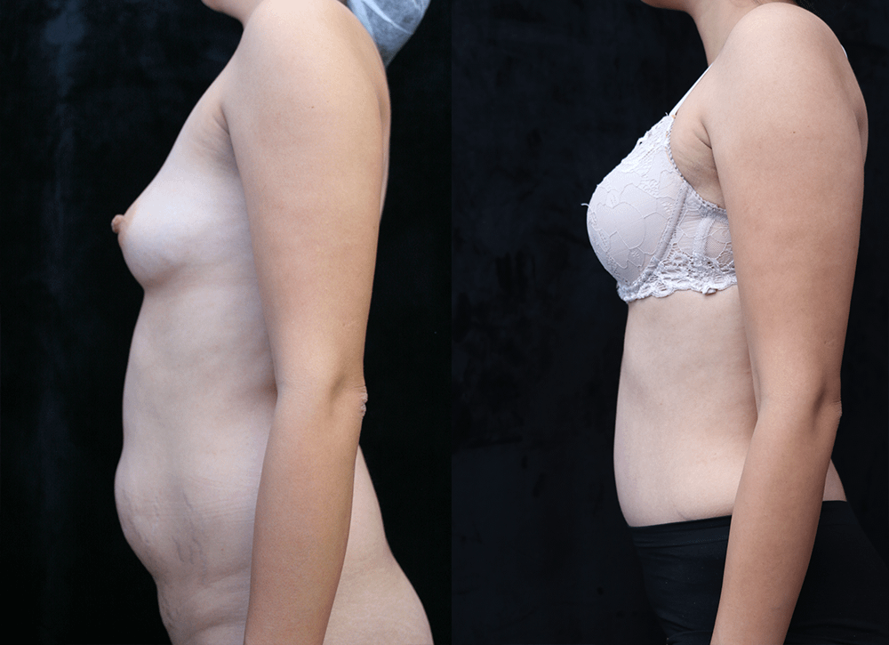 Tummy Tuck Before & After Photos Left Side