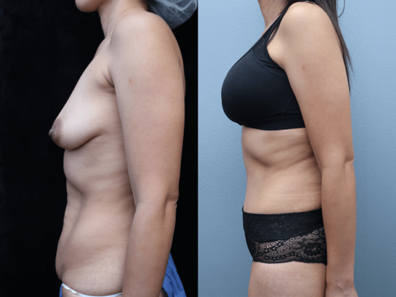 Tummy Tuck Before & After Photos Left Side