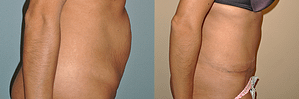 Tummy Tuck Before & After Photos