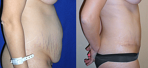 Tummy Tuck Before & After Photos