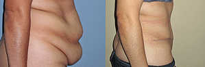 Tummy Tuck Before & After Photos