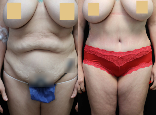 Tummy Tuck Before & After Photos
