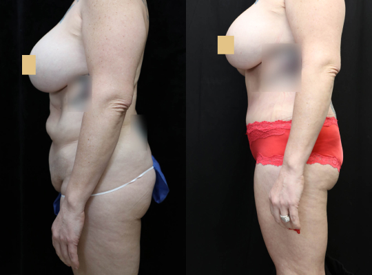Tummy Tuck Before & After Photos