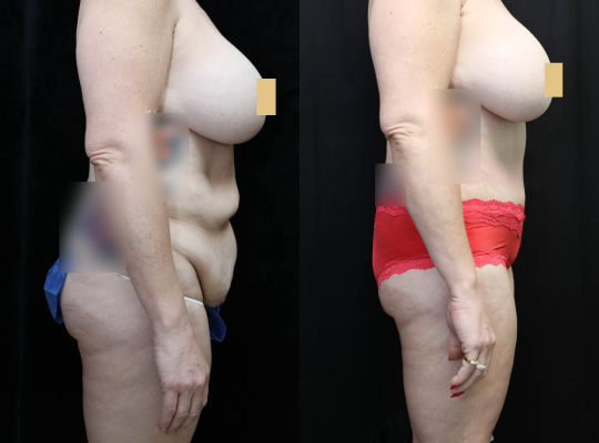 Tummy Tuck Before & After Photos