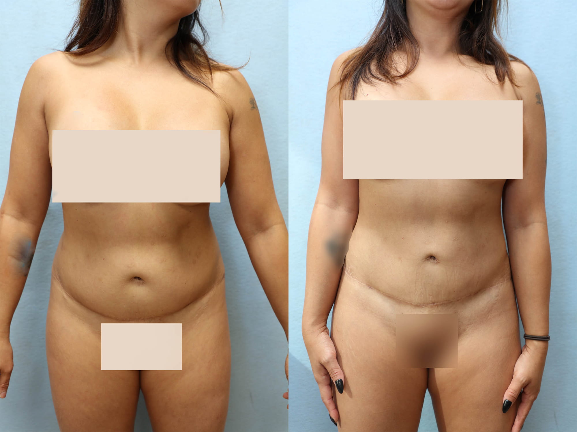 Tummy Tuck Before & After Photos