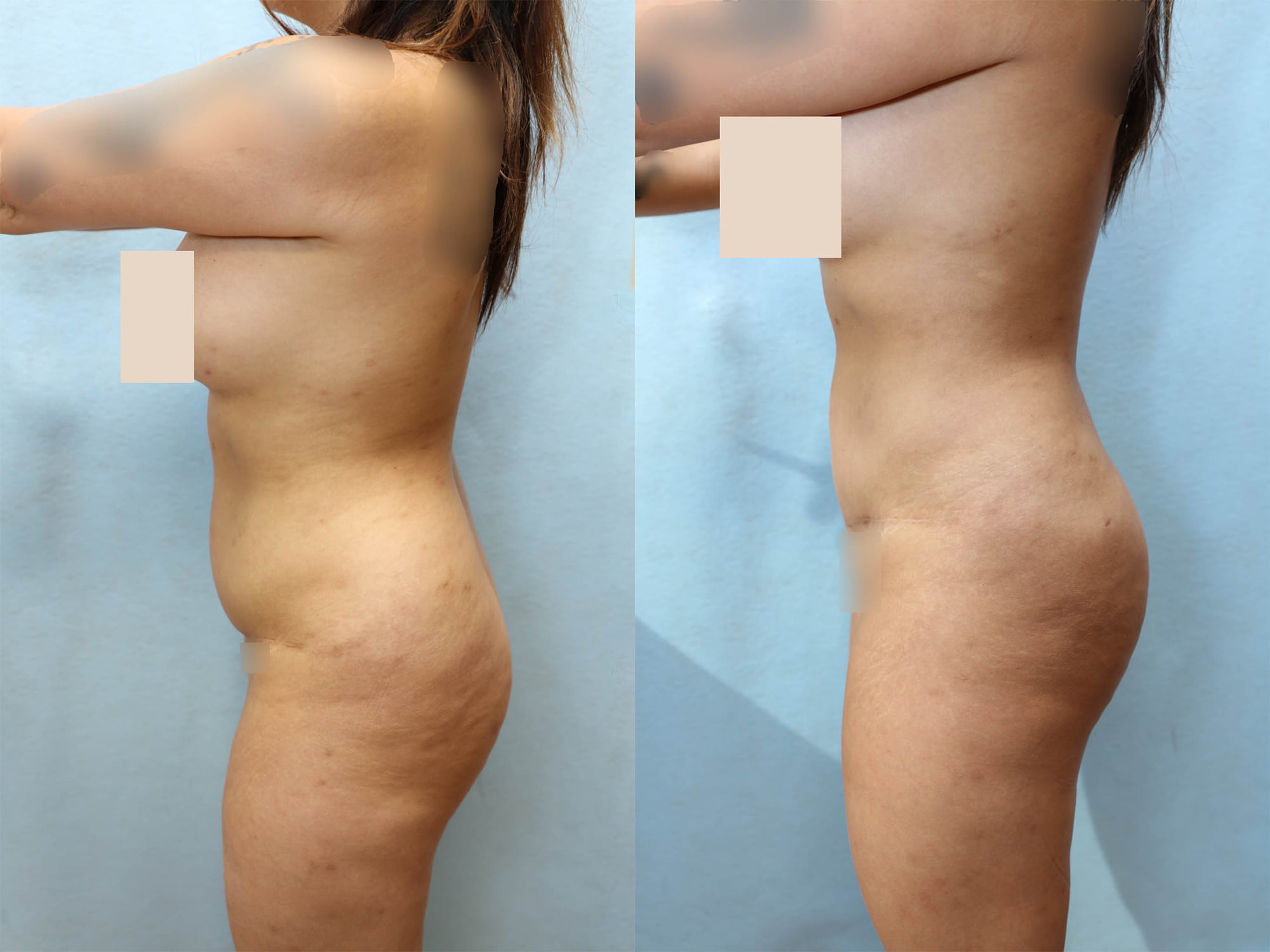 Tummy Tuck Before & After Photos